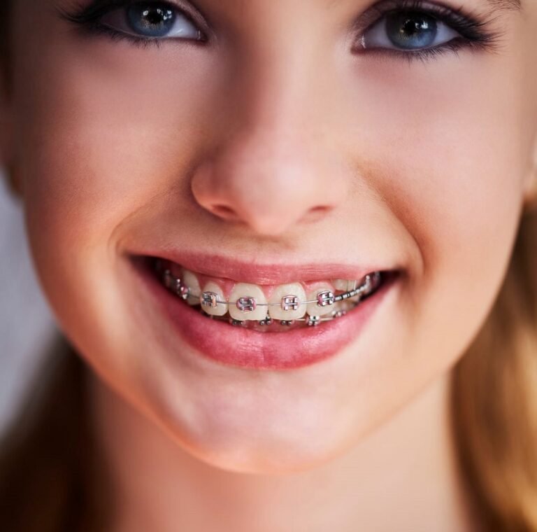 cosmetic dental braces 768x760